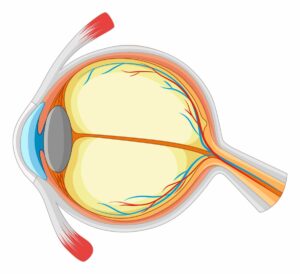 Кератоконус око